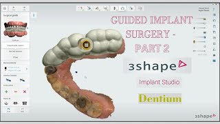 Live Fully Guided Implant Surgery using Dentium Fully Guided kit amp 3Shape Implant Studio Part 2 [upl. by Alisun17]