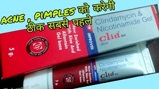 Clid gel for acne uses in hindi  clindamycin amp Nicotinamide gel review in hindi [upl. by Nauqan]