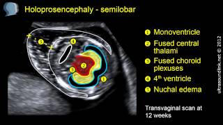 Semilobar holoprosencephaly 2D and 3D ultrasound [upl. by Drarehs]