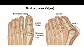 Hallux Valgus Treatment  Cure Hallux Valgus Bunion with Physiotherapy Exercises [upl. by Viguerie]