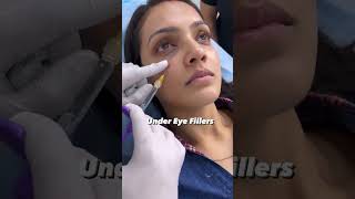 under eye filler treatment helps you get rid of wrinkles  Dermalyn Aesthetics  Dr Muskan Tyagi [upl. by Anah]