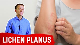 Lichen Planus Best Remedy [upl. by Aloel]