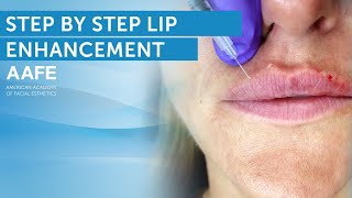 Lip Filler Tutorial  Post Care Procedure [upl. by Haag]