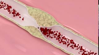 Coronary atherosclerosis animation [upl. by Sateia]