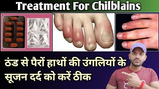 treatment for chilblains ठंड से पैरों हाथों के सूजन दर्द को करें ठीक [upl. by Reichel229]