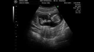 14 week ultrasound Its a Boy [upl. by Nemraciram]