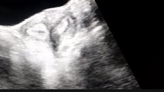 Bicornuate uterus on Ultrasound [upl. by Kalbli]