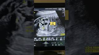 Multi cystic dysplastic kidney MCDK anomaly ultrasound pregnant [upl. by Reinold]