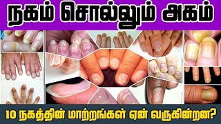 நகம் சொல்லும் அகம்  quotThe Truth Behind Nail Changes Detecting Internal Health Issuesquot theemed [upl. by Glassco]