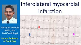 Inferolateral myocardial infarction [upl. by Minne]