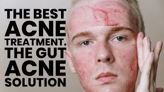 The best ACNE treatment Part 1 The gut acne link [upl. by Auqenes]