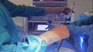 Laparoscopic Hysterectomy [upl. by Nayek]