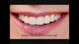 Herbal Dentist  1 Natural Gum Disease Remedy wwwherbaldentistnet [upl. by Nahtanod958]