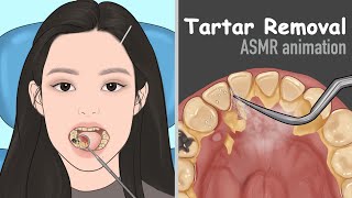 ASMR Tartar removal animation  Dental Scaling  Satisfying [upl. by Jonna901]