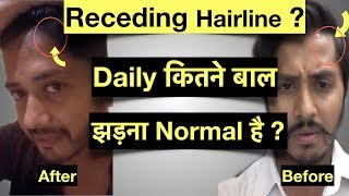 How to grow Receding Hairline How to stop Receding Hair Fall or Hair loss [upl. by Sirromad313]