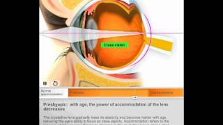 Presbyopia by Quantel Medical [upl. by Eilrahc]