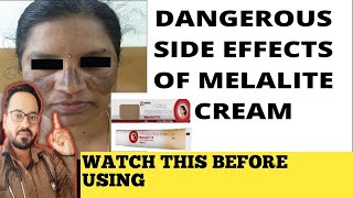 Melalite Cream Review  इस क्रीम का इस्तेमाल ना करें [upl. by Hyo]