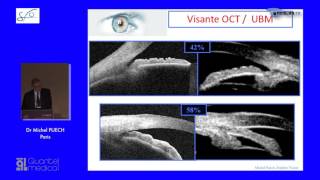 SFO 2017 – UBM et angle iridocornéen dans le glaucome [upl. by Annaj]