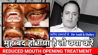 Reduced Mouth Opening Treatment । munh kaise khole। OSMF [upl. by Hardej732]