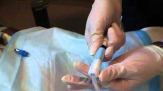 Peritoneal Dialysis Sampling [upl. by Archibold]