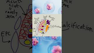 Is atherosclerosis reversible [upl. by Hedelman831]