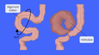 Sigmoid and Cecal Volvulus management surgery [upl. by Marceau]