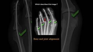 Bone and joint alignment 5 Musculoskeletal Xray General Systematic approach RadiologyChannel [upl. by Amal]