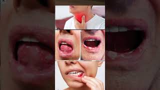 Betadine gargle use in hindi  betadine gargle  Povidone iodine gargle how to use viral shorts [upl. by Viv]