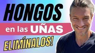 HONGOS en las UÑAS  Tratamiento  Como eliminar Hongos en Uñas de pies y manos  Dr Ludwig Johnson [upl. by Meekar260]