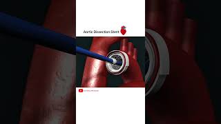 Aortic dissection Stent grafting cardiology shorts [upl. by Labors]