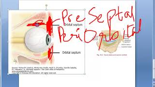 Ophthalmology 417 a Orbital Infection Orbital Cellulitis PreSeptal Post Septal Eye Swelling [upl. by Landre777]