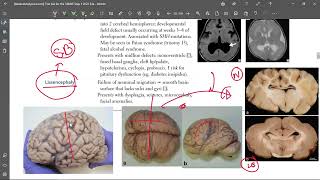 5 Lissencephaly [upl. by Mossman]