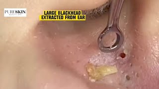 LARGE BLACKHEAD EXTRACTED FROM EAR  PURESKIN Beauty Spa Reacts Dr Dona Cravos asmr [upl. by Ginevra]