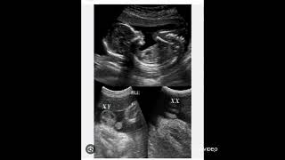 diff bw male and female fetus on ultrasound [upl. by Armelda]