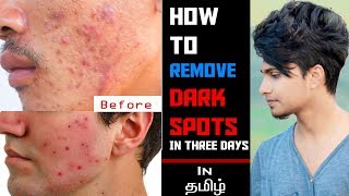 Remove DARK SPOTSBlack Spots In 3 Days IN TAMILSkin Care Tips For Men [upl. by Lorita]