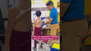 Rare Scoliosis Deformity Treatment By DrRavi scoliosis kyphosis chiropractic chiro shorts reel [upl. by Otrebide821]