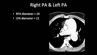 CT and MR Eval of RV Function and Pulmonary Hypertension [upl. by Daraj]