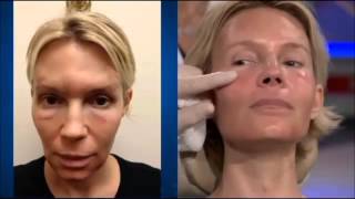 Dr Ourian Demonstrates Fractora  The Mini Face Lift [upl. by Cocke200]