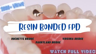 RESIN BONDED FPD  ROCHETTE BRIDGE  MARRYLAND BRIDGE  VIRGINIA BRIDGE fpd prostho [upl. by Asreht422]