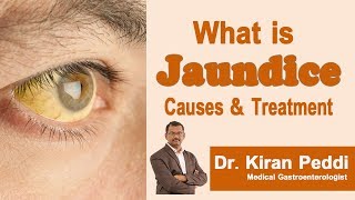 Hi9  What is Jaundice Causes and Treatments  Dr Kiran K Peddi  Medical Gastroenterologist [upl. by Ailecec]