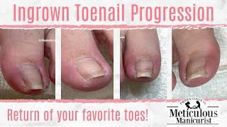 Ingrown Toenail Progression  How To Pedicure Tending to Toenails [upl. by Fletcher190]