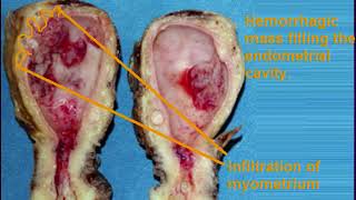 Endometrial carcinoma gross and microscopic features for medical students [upl. by Call]