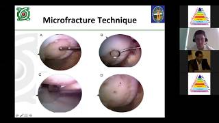 Matrix Encapsulated Autologous Chondrocyte Implantation [upl. by Nmutua]