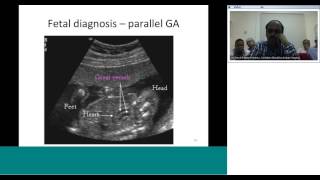 dTGA diagnosis and preoperative assessment by Dr Sivakumar [upl. by Suolhcin]