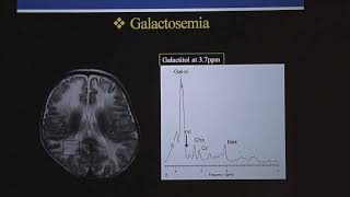 TMT Pediatric White Matter Diseases  Part III by Dr Deepak Patkar [upl. by Abdu46]