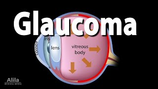 Development of Glaucoma Animation Open Angle vs Angle Closure Glaucoma [upl. by Aissac]