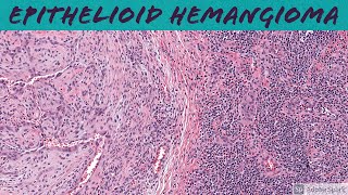 Epithelioid Hemangioma aka ALHE 5Minute Pathology Pearls [upl. by Gnak]