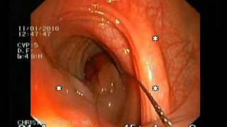 POLYPECTOMY OF A LARGE STALK POLYP CHRISTOS KARALIS MD WMV [upl. by Mcclain568]