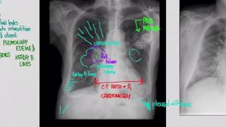 CXR Congestive Heart Failure CHF [upl. by Nae]