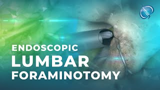 What is Endoscopic Lumbar Foraminotomy [upl. by Noryv]